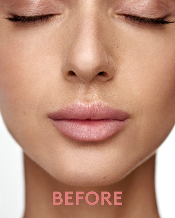 ערכת ליפ קיט נטע - לפני